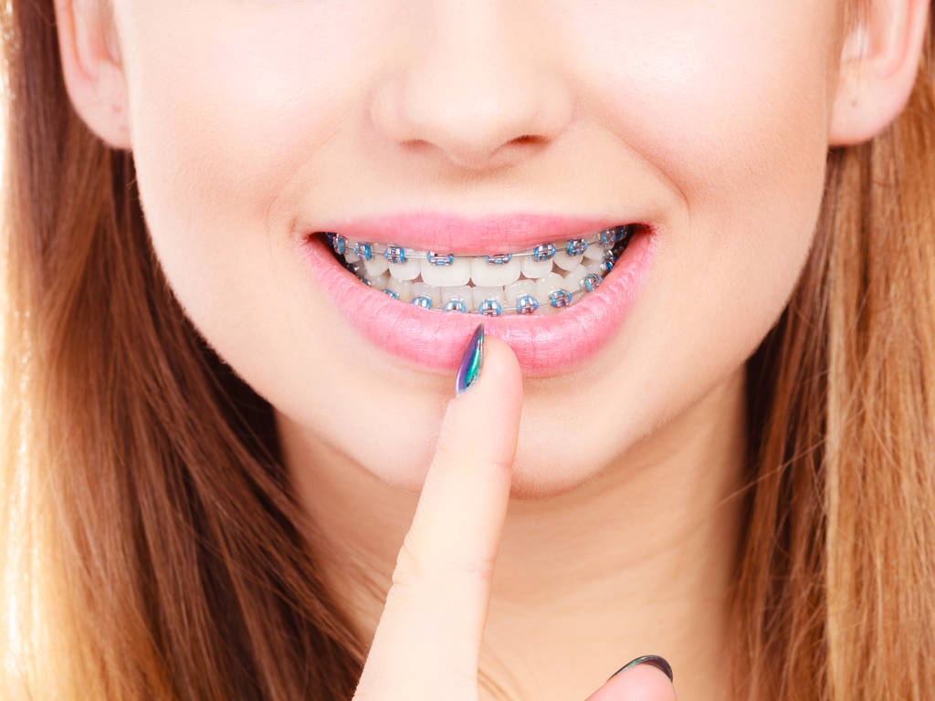 Woman showing her teeth with braces