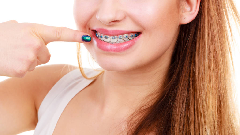 Ceramic Braces
