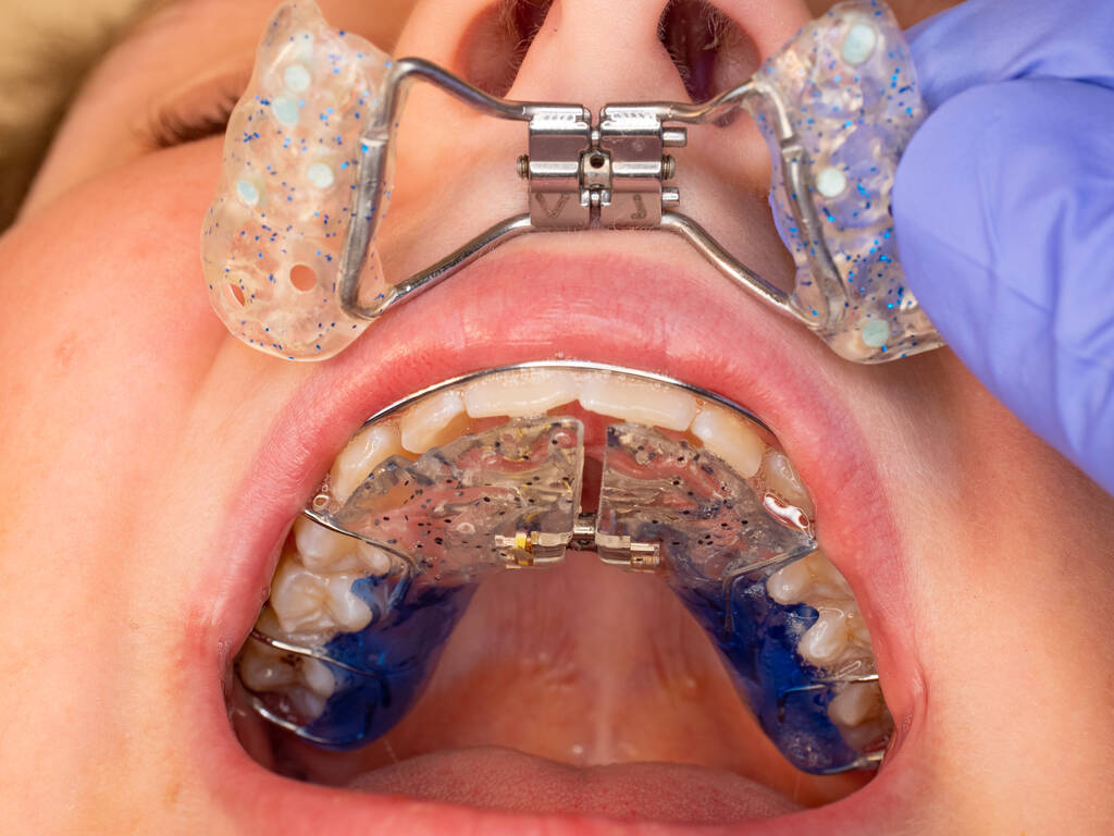 How Long Should a Permanent Retainer Stay In