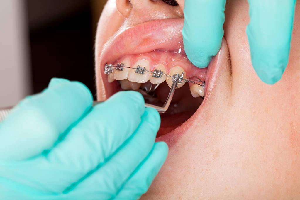 How Permanent Retainers Are Install
