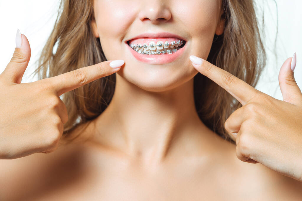 How do ceramic braces work?