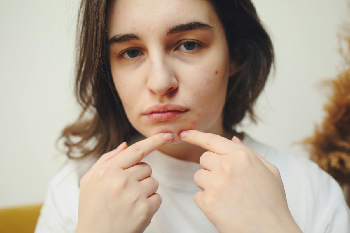 I Tried Everything for My Acne Here’s What Helped