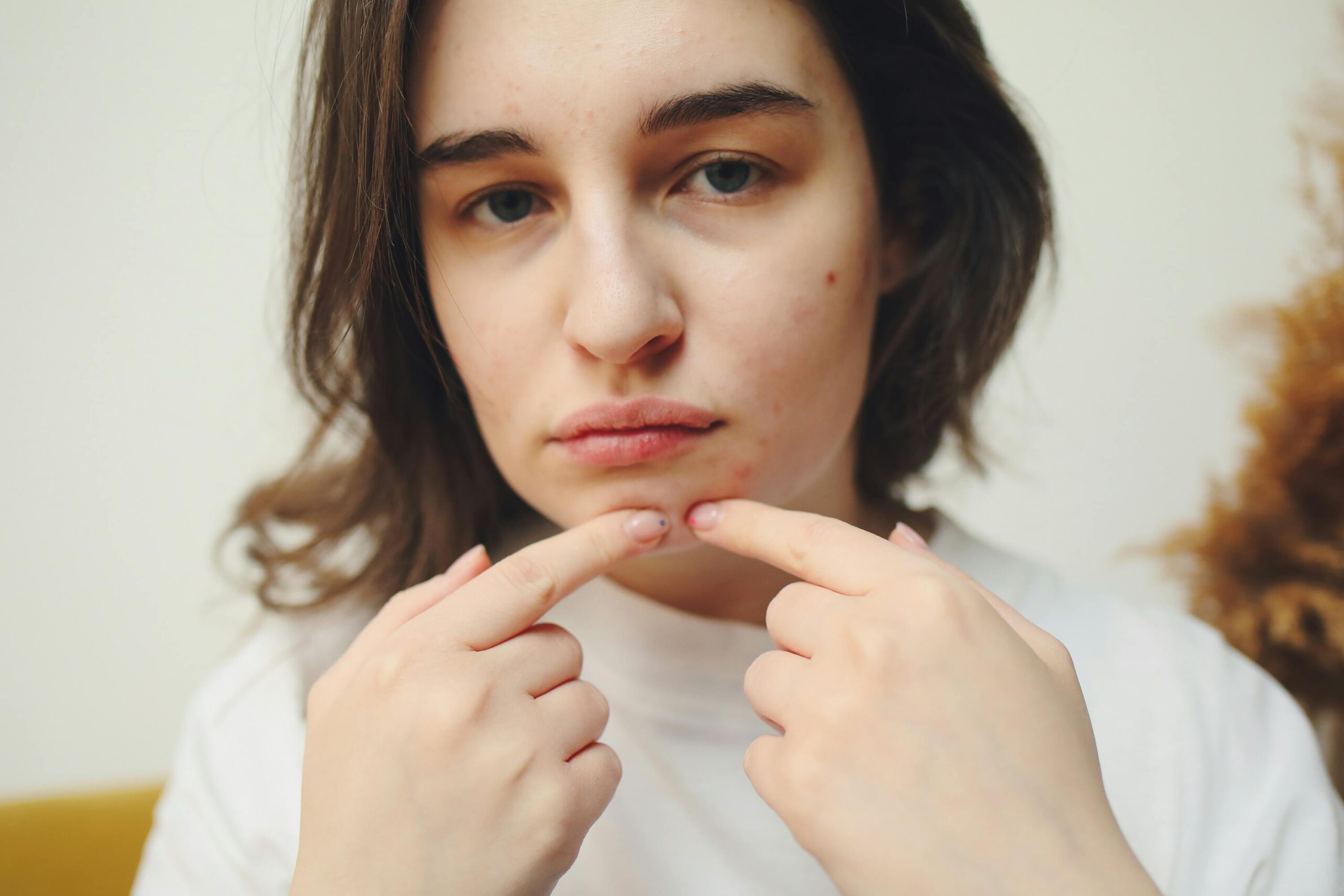 I Tried Everything for My Acne Here’s What Helped