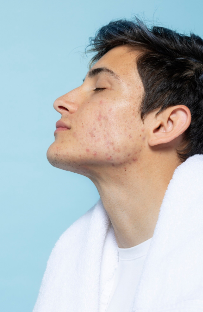 The Lightbulb Moment Not All Acne Is the Same