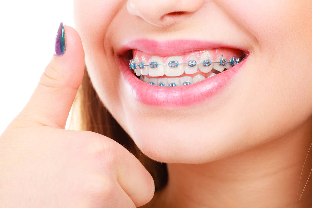 Who Should Get Ceramic Braces