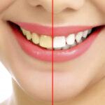 Explore the Stunning Before and After Photos of Teeth Whitening Results