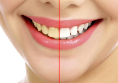 Explore the Stunning Before and After Photos of Teeth Whitening Results