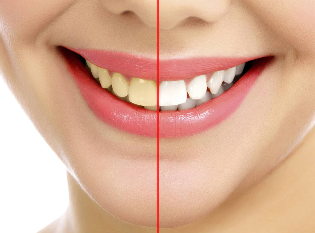 Explore the Stunning Before and After Photos of Teeth Whitening Results