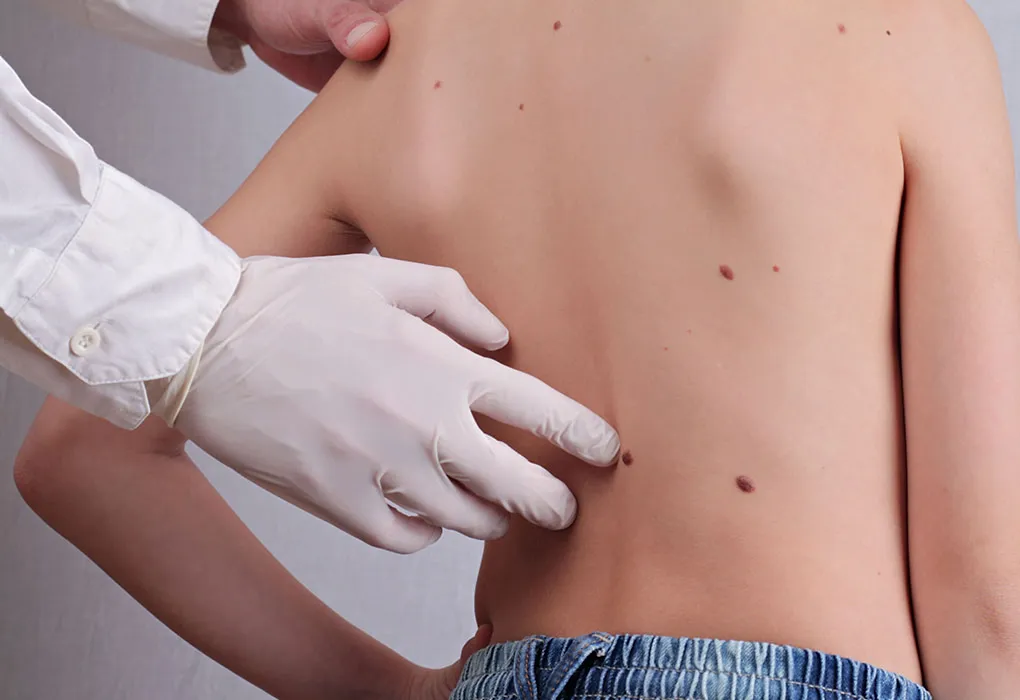 The Best Mole Remover for Smooth Skin For Children