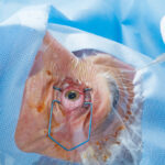 patients comparing cataract surgery providers in Houston
