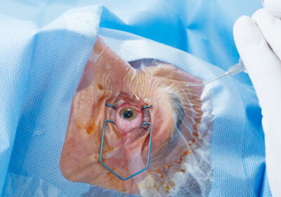 patients comparing cataract surgery providers in Houston