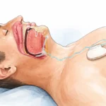 A CPAP Alternative That Works