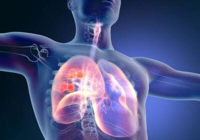Clinical Perspectives on Patient Selection for First-Line HER2+ GEA treatment